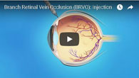 Branch Retinal Vein Occlusion (BRVO): Injection