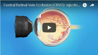 Central Retinal Vein Occlusion (CRVO): Injection & Laser