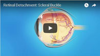 Retinal Detachment: Scleral Buckle