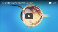 Retinal Detachment: Vitrectomy